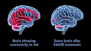 EMDR Treatment - brain activity